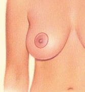 cicatrice lifting des seins par round block